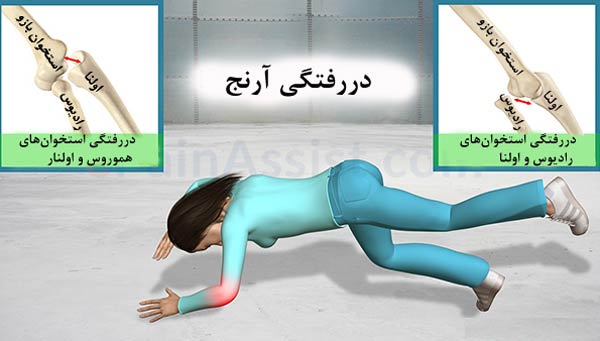 نام: دررفتگی1.jpg نمایش: 197 اندازه: 27.9 کیلو بایت